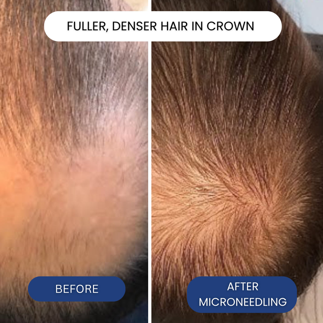 Micro-Infusion System For Hair Regrowth