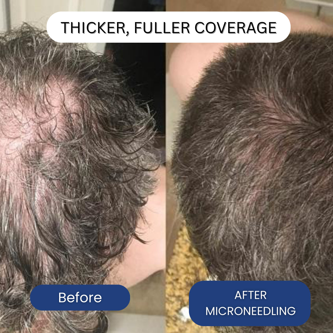Micro-Infusion System For Hair Regrowth