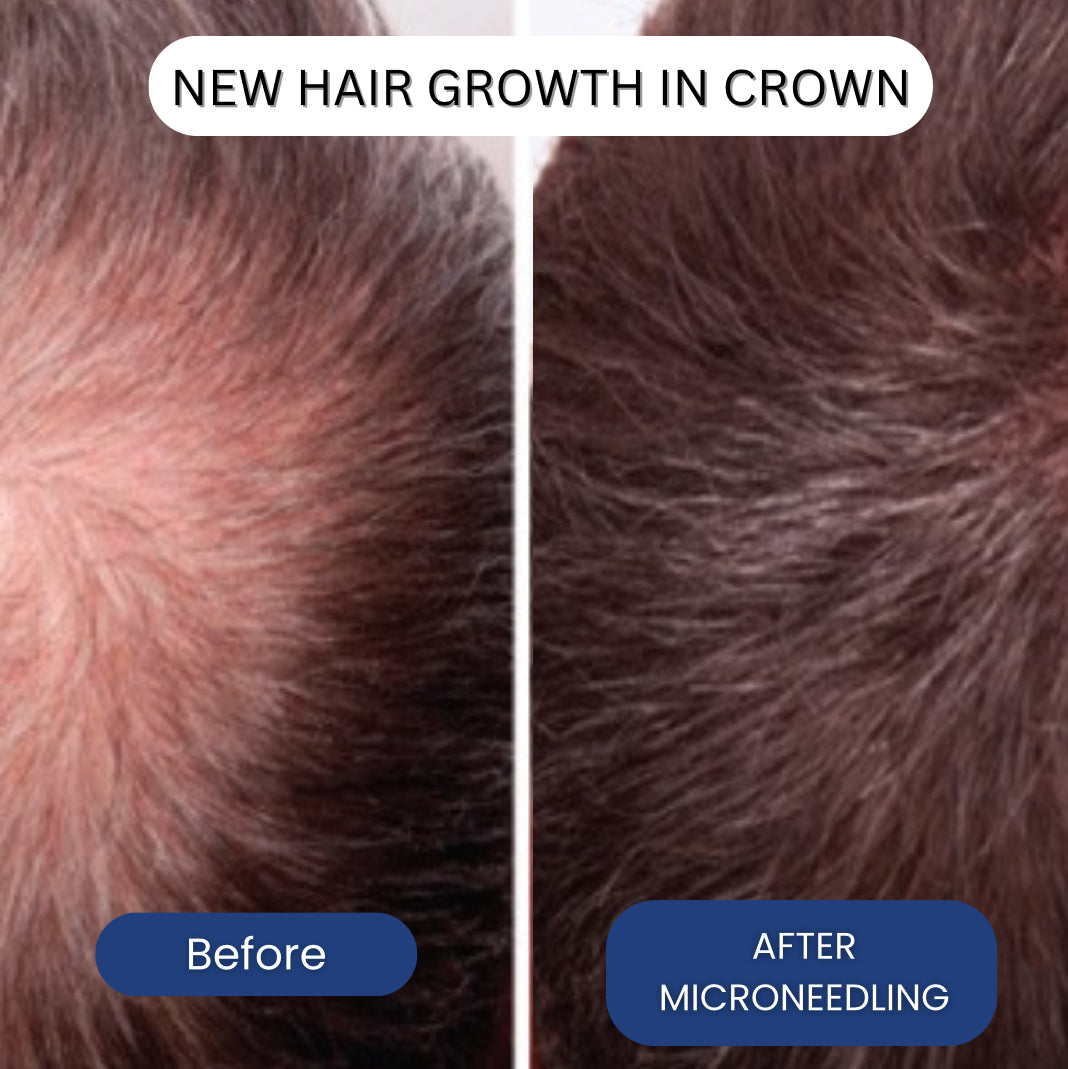 Micro-Infusion System For Hair Regrowth