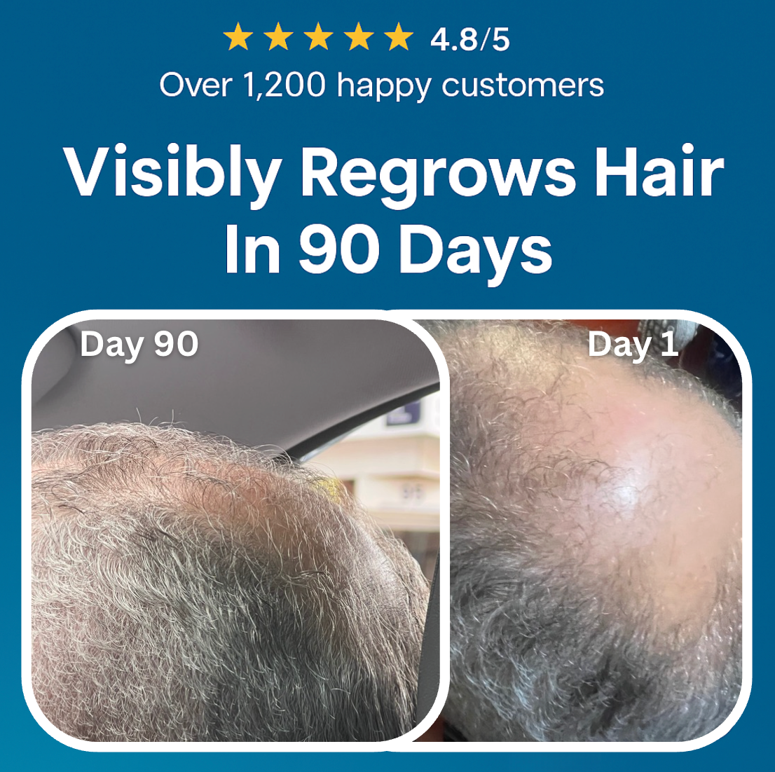 Peptonix Micro-Infusion System For Hair Regrowth